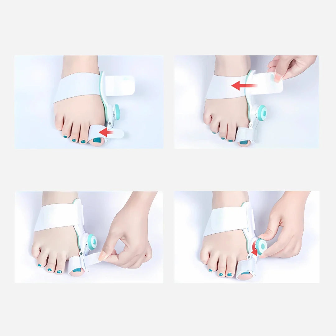 Justerbar tåkorrektor til hallux valgus og bunion korrektion